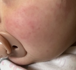 Is this what slapped cheek looks like?