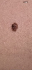Do these moles look normal?