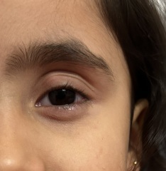 Spots in eye