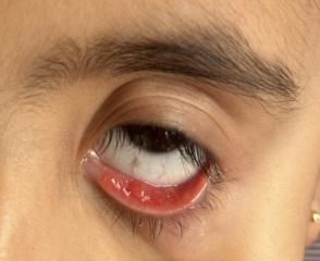 Spots in eye
