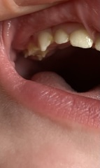 Toddler teeth concern - could this be decay?