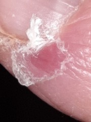 Agonising infected finger - photos.