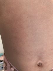 4 year old with fever and rash !
