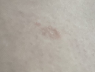 Is this shingles?
