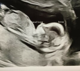 Boy or Girl? Nub guess