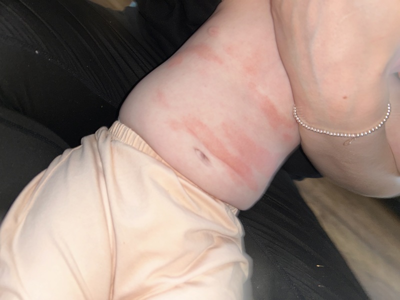 Baby eczema keeps spreading