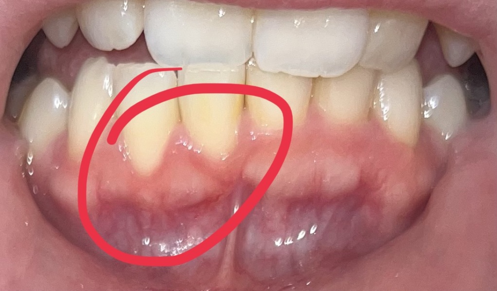 Two teeth receding *picture attached* - reassurance seeker!