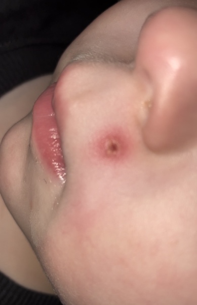 Does this chicken pox look infected please?! Anxious!