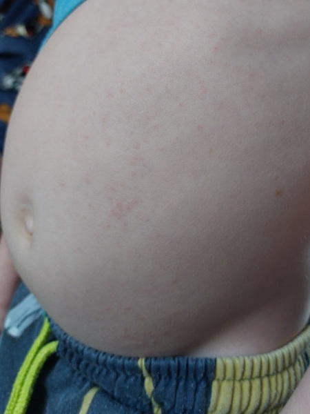 rash spreading
