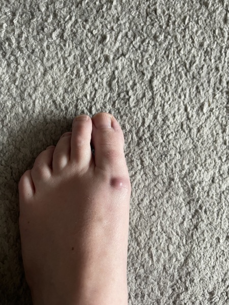 Bump on foot