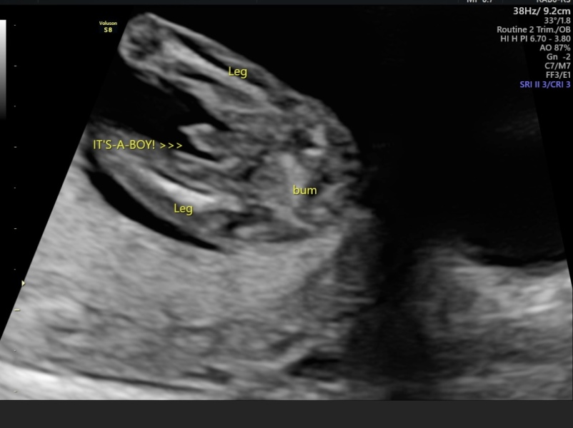 Gender scan looks like girl or boy