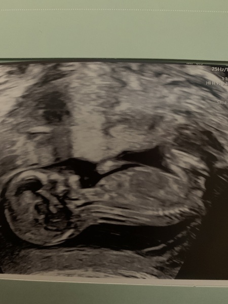 Nub and skull theory!