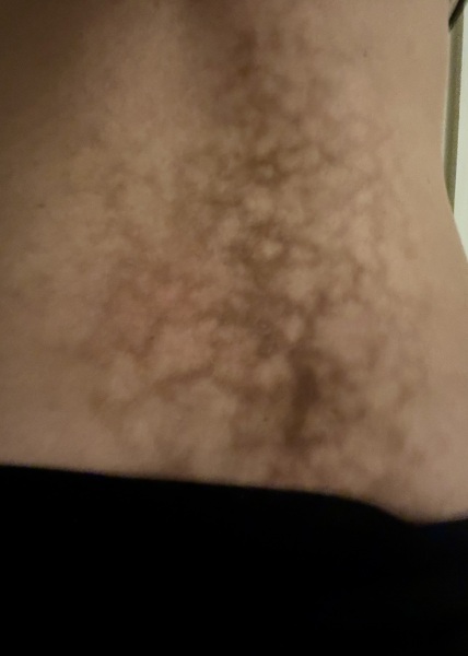 Rash from hot water bottle *image included*