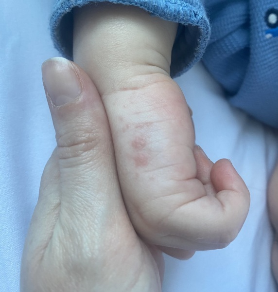 Scabies?