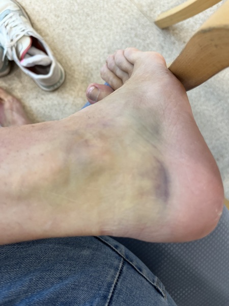 To not worry about my manky foot (horrible pic included)