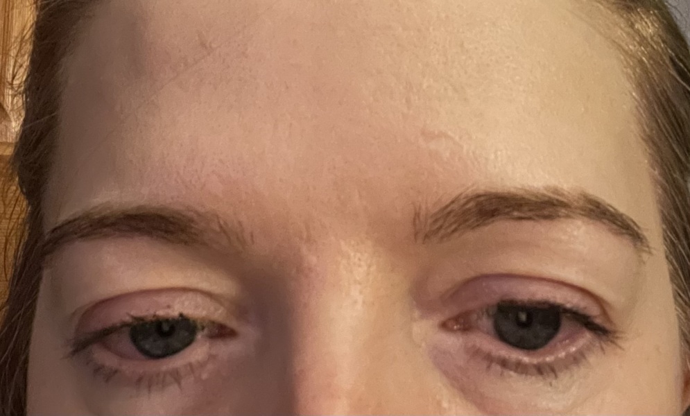 Eyelids worse after Botox ? Pic included