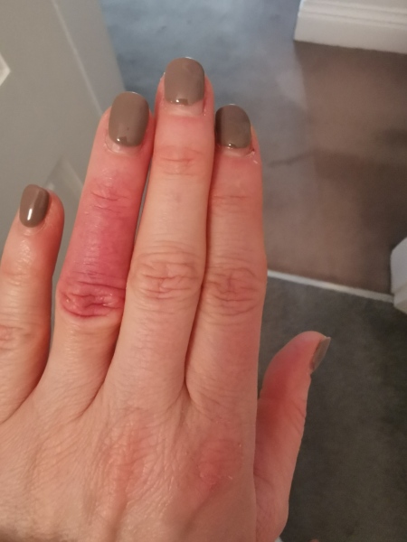 Why has my finger turned purple?!