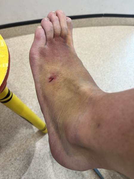 To not worry about my manky foot (horrible pic included)