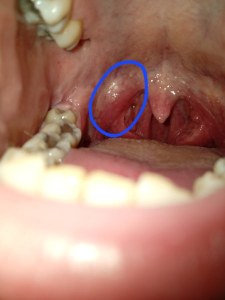 Anyone seen anything like this? Tonsil stone/cyst/abscess
