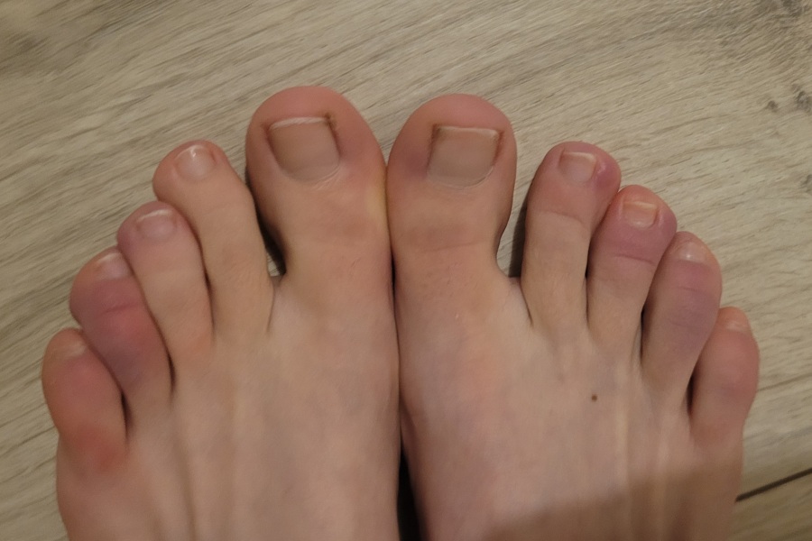 Are these purple toes normal (pic warning)