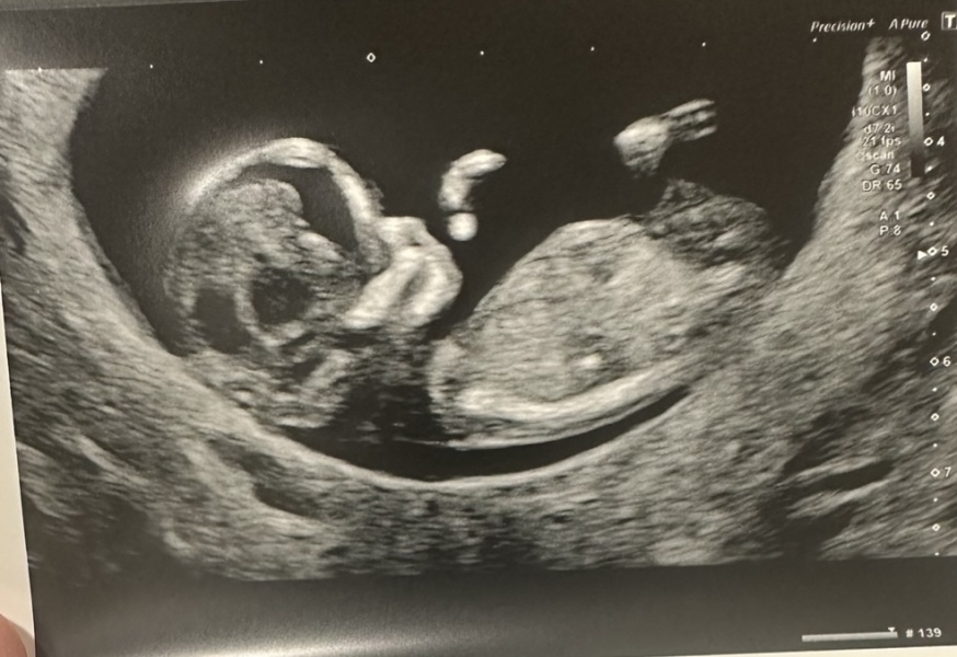 Nub theory - boy or girl? 12 wks 2 days