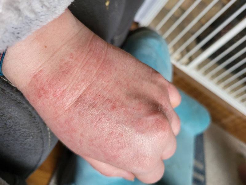 Hydrocortisone when pregnant