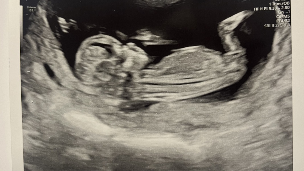 Pregnancy after loss support