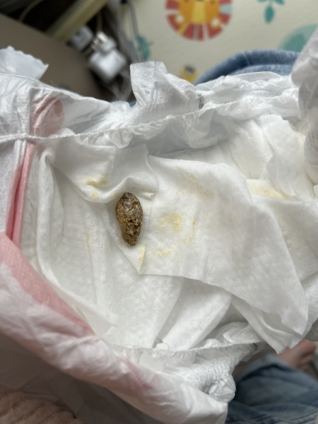 White bits on baby's poop