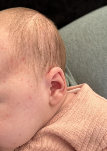 Is this baby acne?