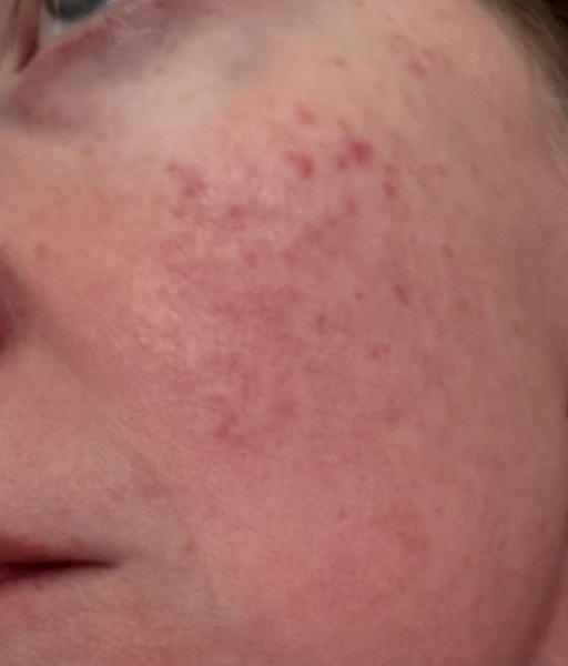 Are these spots or rosacea?