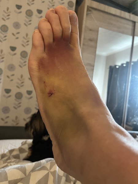 To not worry about my manky foot (horrible pic included)