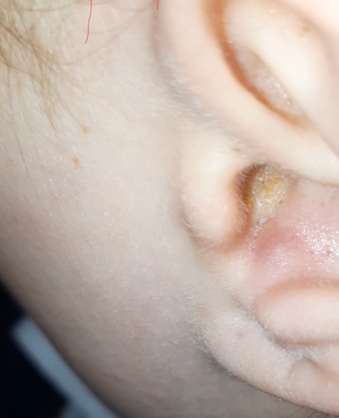 Lump inside ear? Pic included