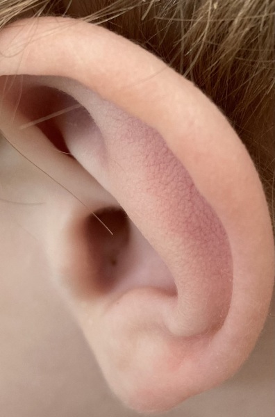 Blackhead in 2yr old's ear