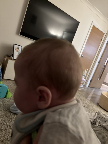 How severe is this plagiocephaly?