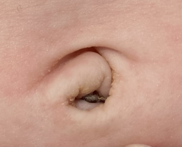 Retained tissue inside baby’s belly button - normal?