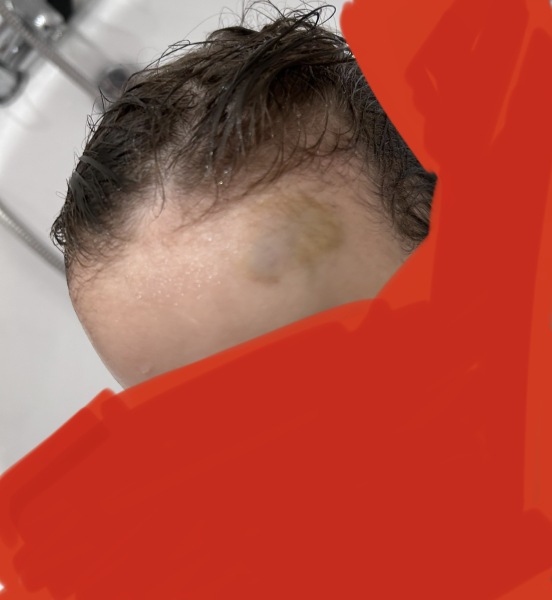 4 Year Old head bump Wednesday. Still swollen today.