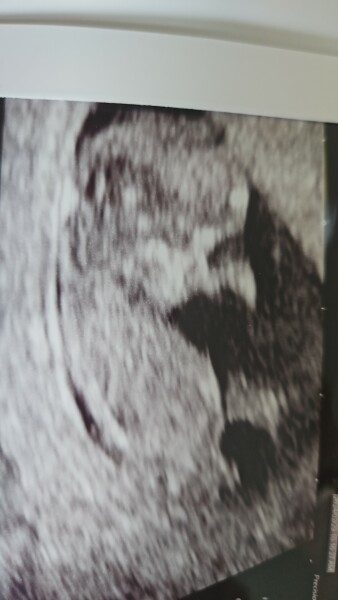 11 week scan - nub theory 