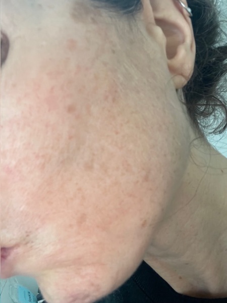 Are chemical peels helpful for this sort of skin damage? Pic included