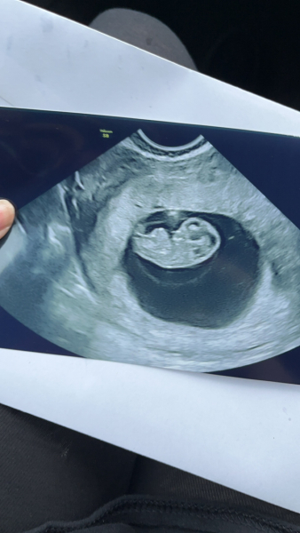 Private Scan at 8 Weeks