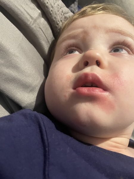 Toddler has fever !