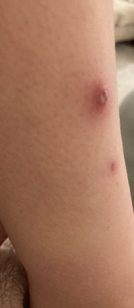 Recurring spots on DDs leg