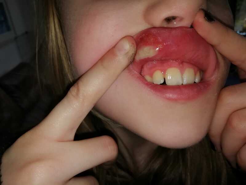 Dental abscess, extraction and now this???