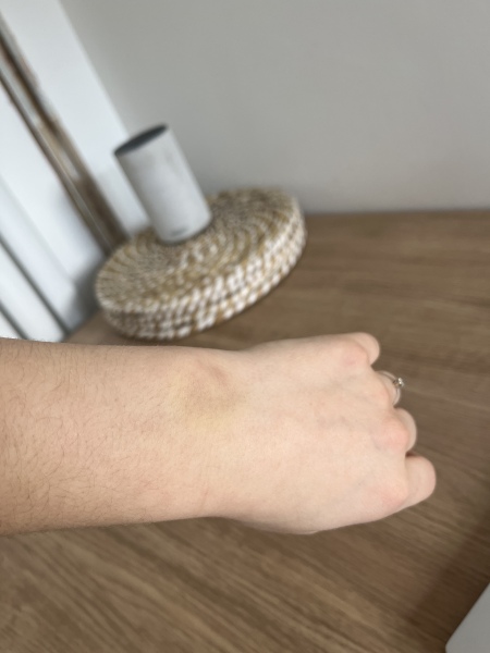 Worried about blood clot in arm