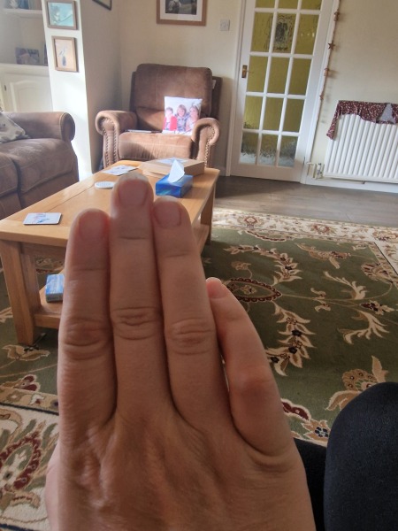 Would you seek medical attention for a potentially broken finger?