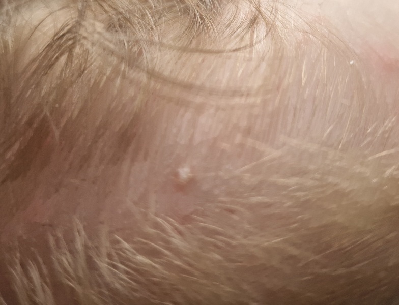Whitehead on one year old's scalp that isn't going away
