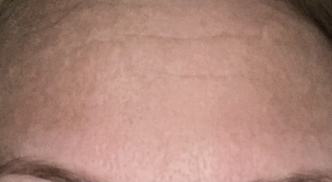 Reduce Wrinkles or Frown Lines