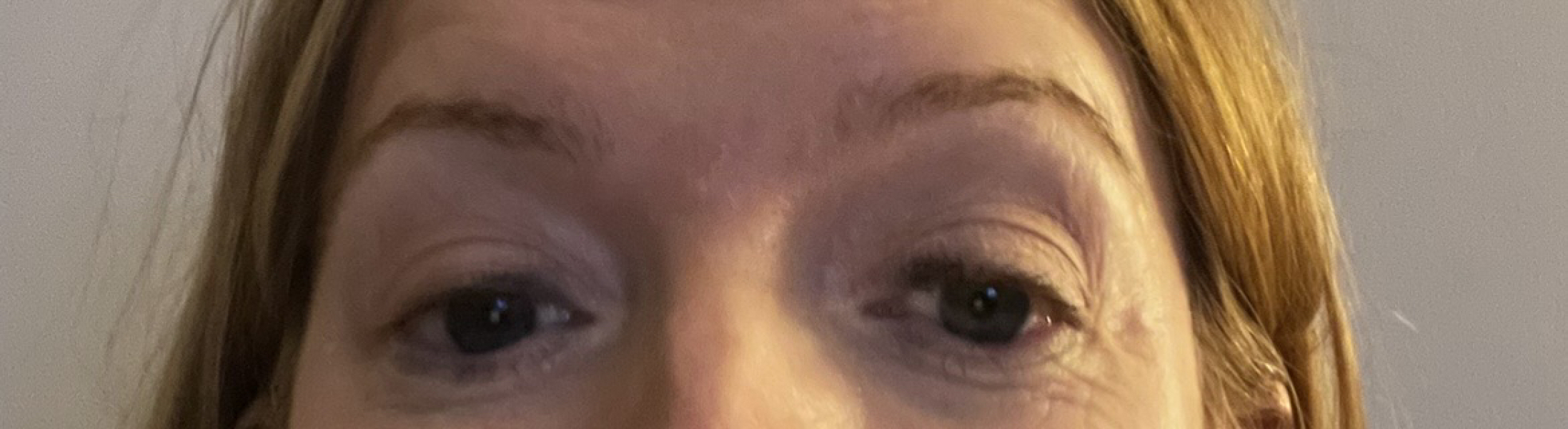 Eyelids worse after Botox ? Pic included
