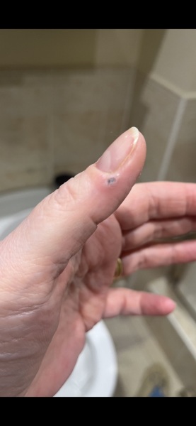 Wart/verucca - any experts?