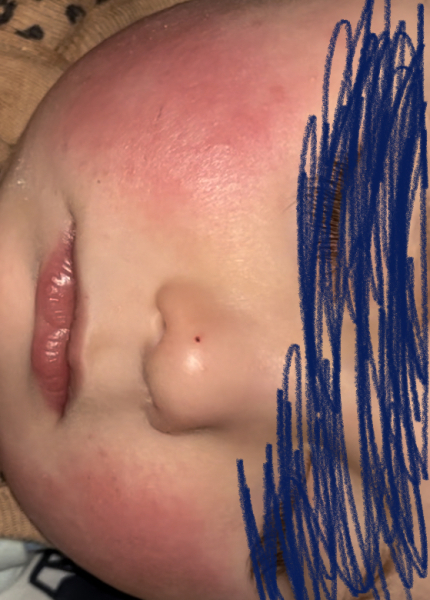 Teething or allergy?