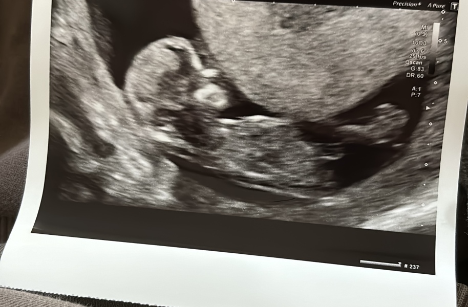 NUB THEORY GUESSES FOR TWINS 🩷💙